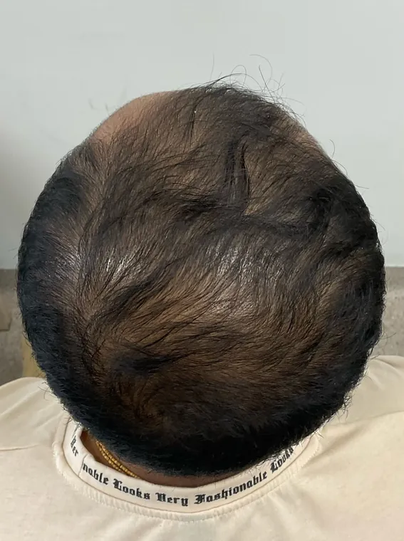 Client 1 after 4 PRP sessions