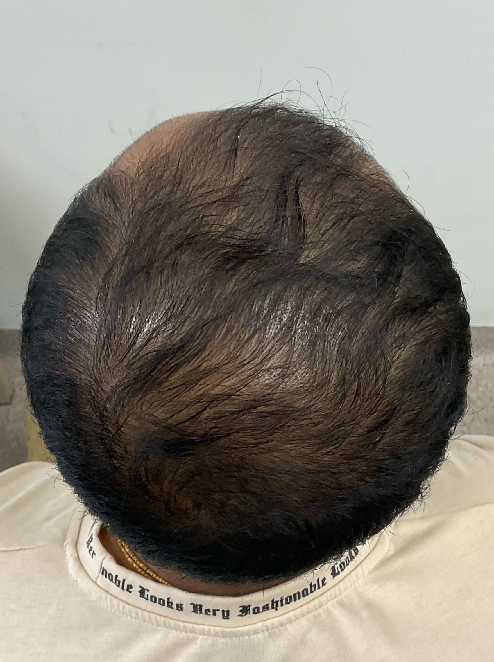 Client 1 after 4 treatment sessions