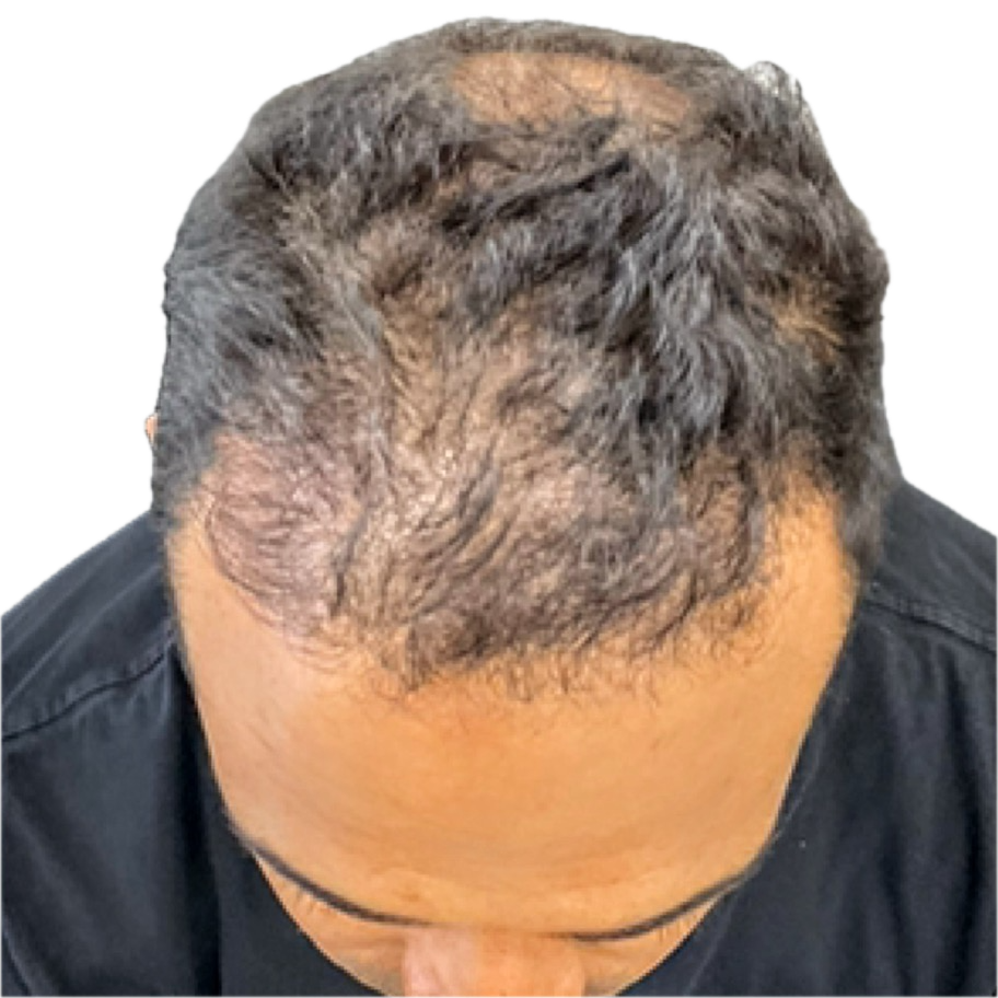 Client 3 after 5 Hair Revive sessions