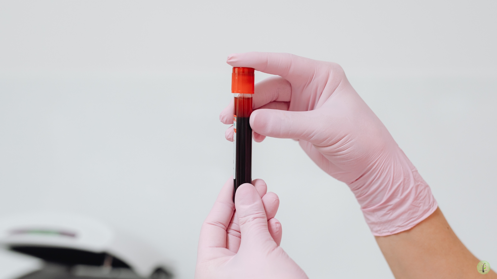 PRF platelet rich fibrin scalp treatment