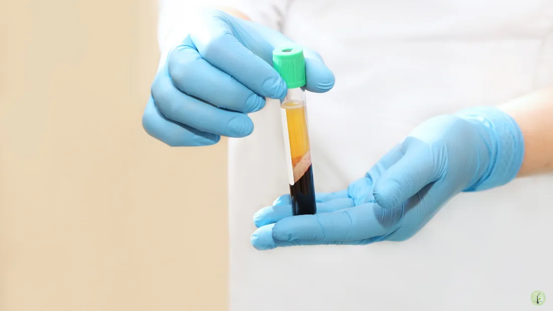 PRP blood plasma centrifuge treatment